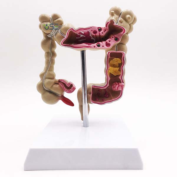 Medical Diseases Colon Model